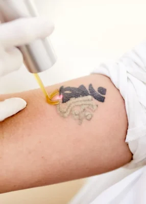 Tattoo verwijdering pico laser